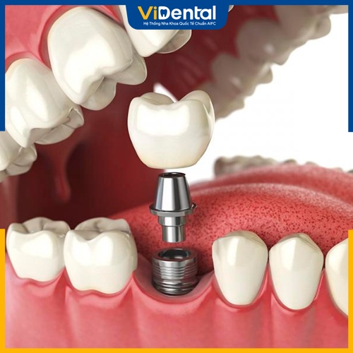 Trồng răng Implant được áp dụng cho tình trạng gãy răng toàn phần 