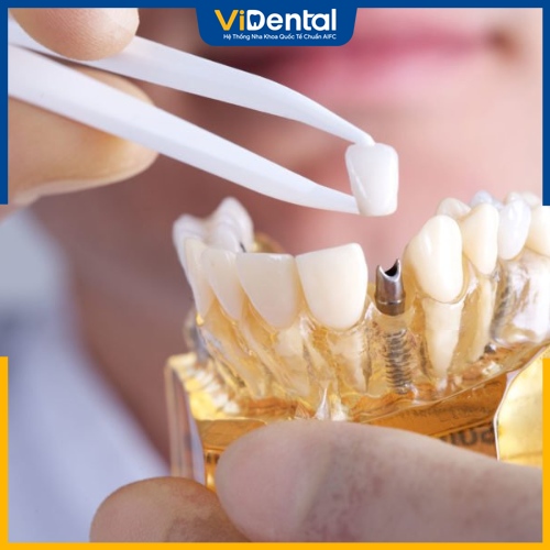 ViDental Clinic cam kết chất lượng răng sứ đạt chuẩn 