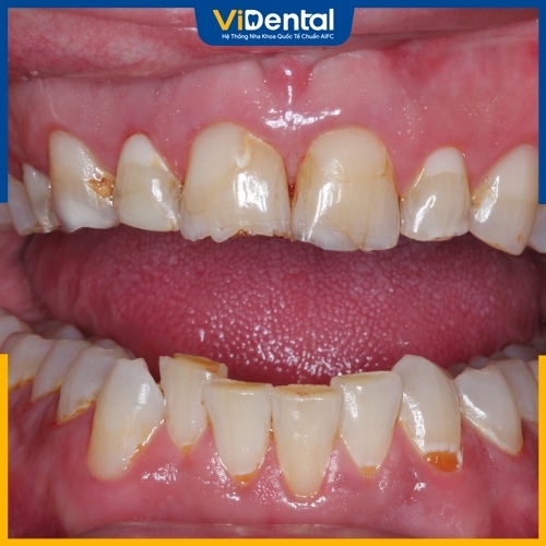 Răng bị mài mòn do các phản ứng hóa học trong khoang miệng