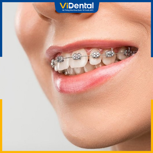 Niềng răng giúp các răng dịch chuyển về đúng vị trí