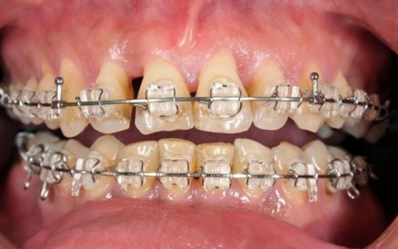 Khi niềng răng không vệ sinh cẩn thận có thể gây ra một số bệnh lý nha khoa