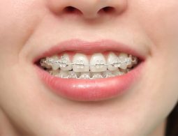 Niềng răng có ảnh hưởng gì không?