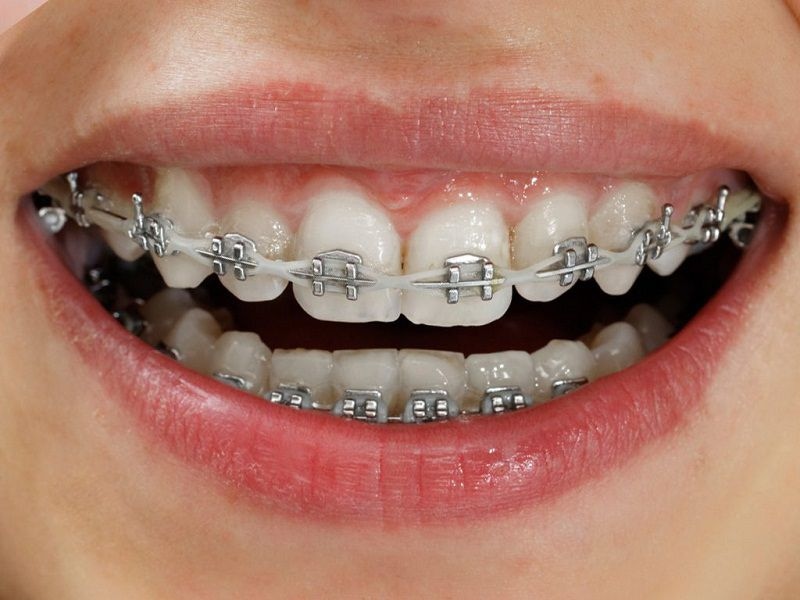 Niềng răng có ảnh hưởng gì không sẽ phục thuộc vào nhiều yếu tố khác nhau