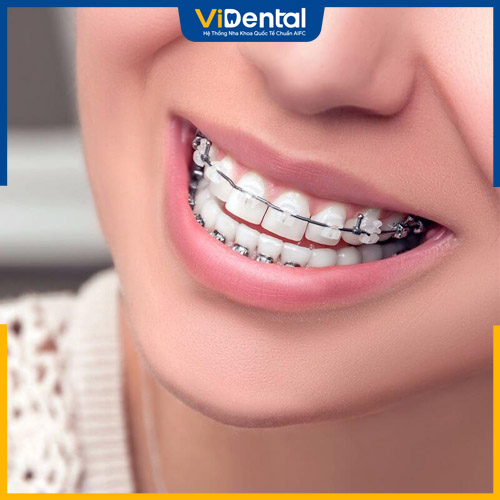 Niềng răng là một trong những phương pháp chỉnh nha hiệu quả
