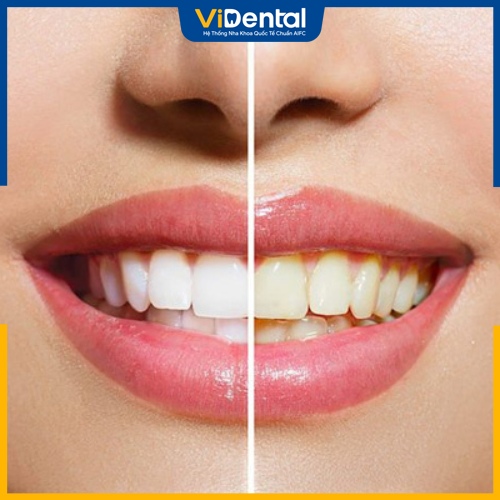 Răng ố vàng do yếu tố di truyền hoặc bệnh lý mãn tính 
