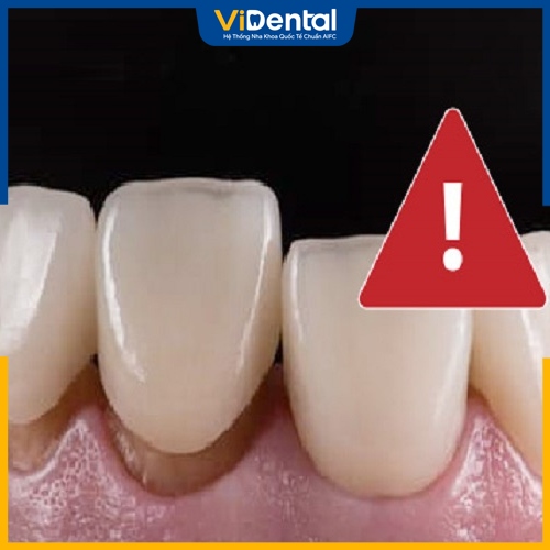 Răng sứ lung lay gây ra nhiều hậu quả nghiêm trọng 
