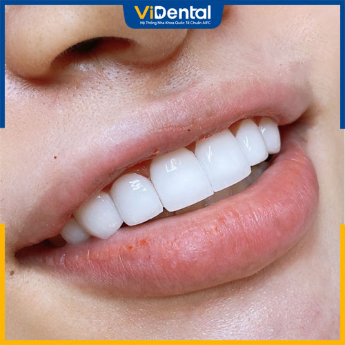 Răng sứ Cercon HT (High Translucent) là răng toàn sứ