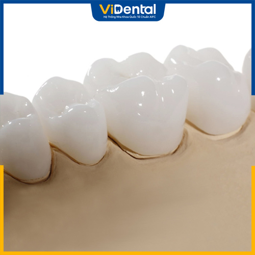 Giá răng sứ Cercon HT phụ thuộc vào nhiều yếu tố