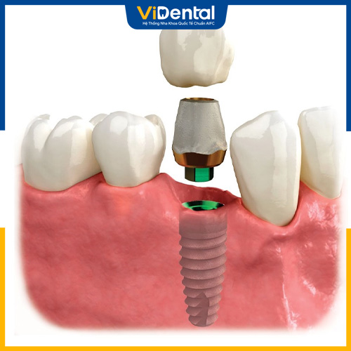 Loại răng này có thể dùng để phục hình Implant