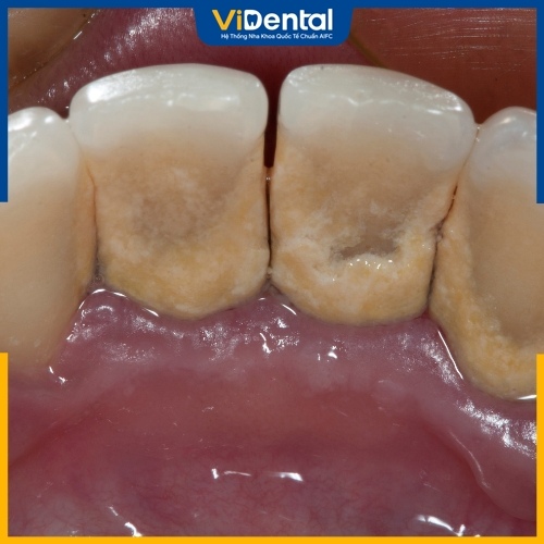 Mảng bám cao răng tích tụ vi khuẩn gây sâu răng