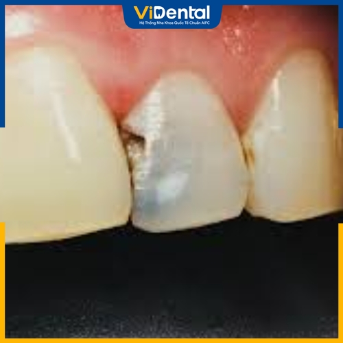 Lỗ sâu răng cửa xuất hiện nếu không điều trị kịp thời