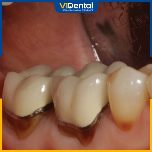 Bọc sứ răng hàm giúp khắc phục tình trạng sâu hiệu quả 