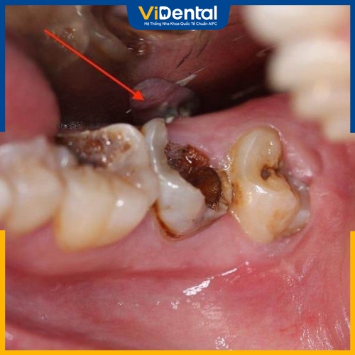 Sâu răng nặng gây đau nhức và phát sinh nhiều bệnh lý khác 