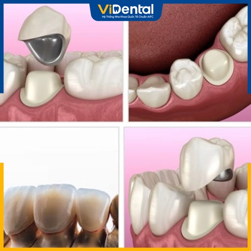 Bọc sứ giúp khắc phục răng sâu hiệu quả
