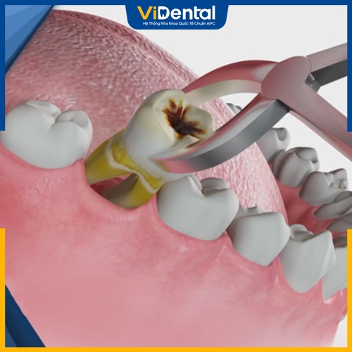 Nhổ răng sâu và cấy trụ Implant để điều trị sâu răng nặng