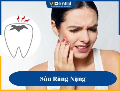Sâu răng nặng gây đau nhức