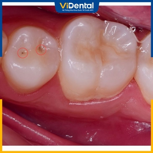 Sâu răng nhẹ có thể gặp ở mọi lứa tuổi