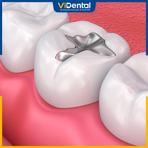 Trám răng xử lý được răng sâu ở nhiều mức độ