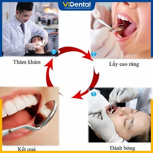 Quy trình lấy cao răng được thực hiện nhanh chóng, an toàn và hiệu quả thông qua 4 bước