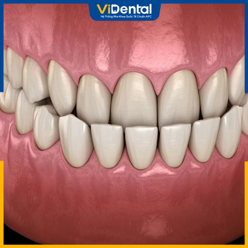 Răng móm là tình trạng sai lệch khớp cắn thường gặp