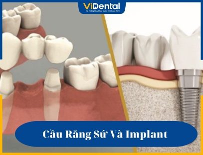 Cầu răng sứ và Implant