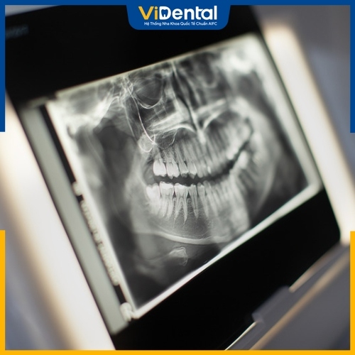 Chụp X-quang răng sử dụng trong mọi ca điều trị nha khoa