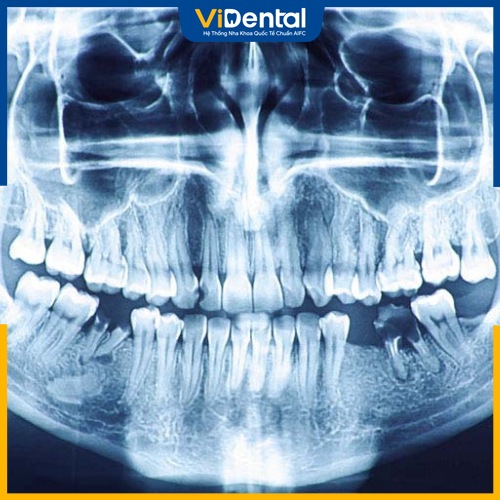 Chụp X-quang răng có hại không là thắc mắc của nhiều khách hàng 