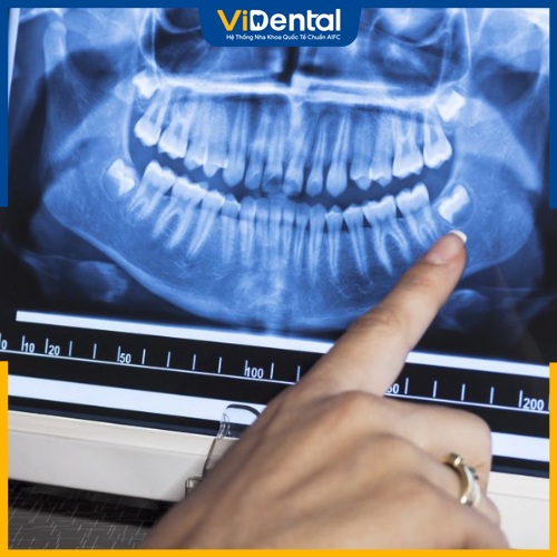 Chụp X-quang răng khôn bằng công nghệ kỹ thuật số 