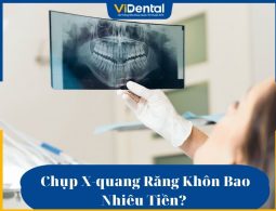 Chụp X-quang răng khôn bao nhiêu tiền