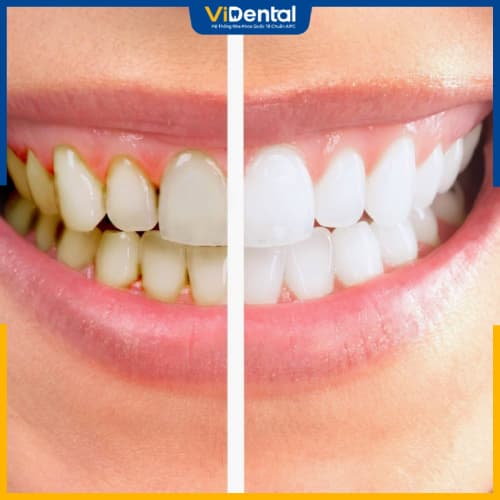 Lấy cao răng định kỳ sẽ đem lại những lợi ích tuyệt vời khiến bạn bất ngờ