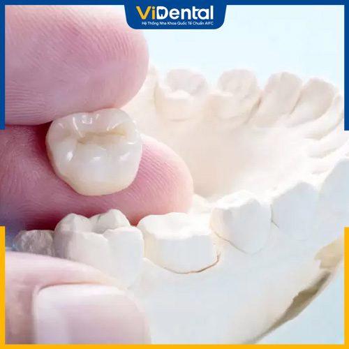 Phục hình răng sứ là dịch vụ nha khoa thẩm mỹ phổ biến