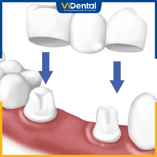Cầu răng sứ đảm bảo khả năng ăn nhai và tính thẩm mỹ