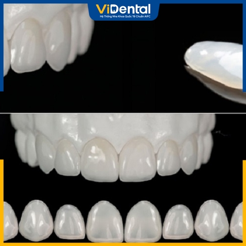 Dòng răng sứ cao cấp cũng được sử dụng để phục hình Implant 