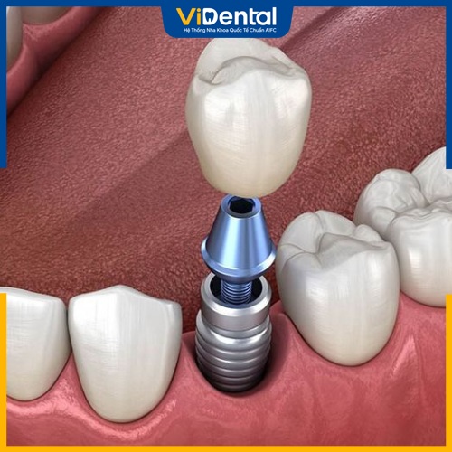 Răng sứ trên Implant hoàn toàn có thể thay mới