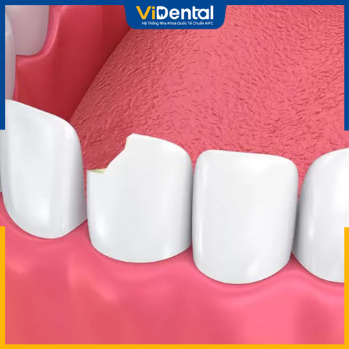 Răng sứ có thể bị sứt mẻ do nhiều nguyên nhân