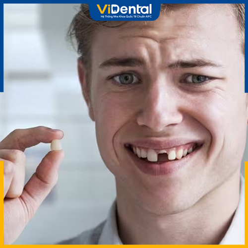 Răng sứ nứt vỡ tăng nguy cơ mất răng thật