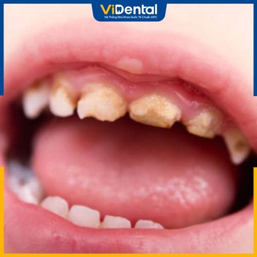 Sâu răng gây ảnh hưởng không tốt cho trẻ nhỏ