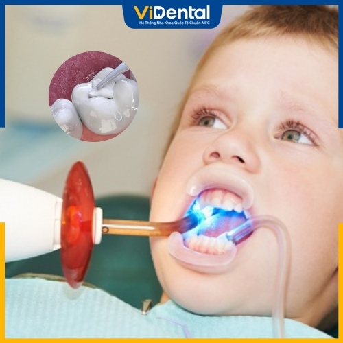 Quy trình trám răng cho trẻ 4, 5 tuổi