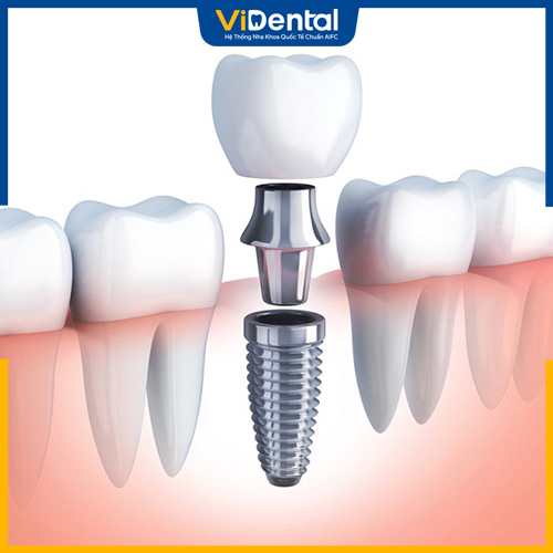 Trồng răng Implant là phương pháp phục hình răng phổ biến