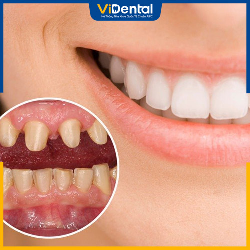 Trồng răng sứ giúp phục hình răng hiệu quả