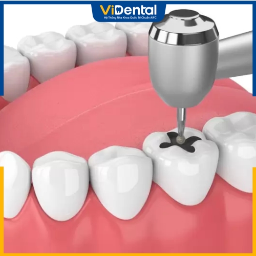Răng bị sâu, mẻ, mòn cổ răng thì nên áp dụng biện pháp trám răng