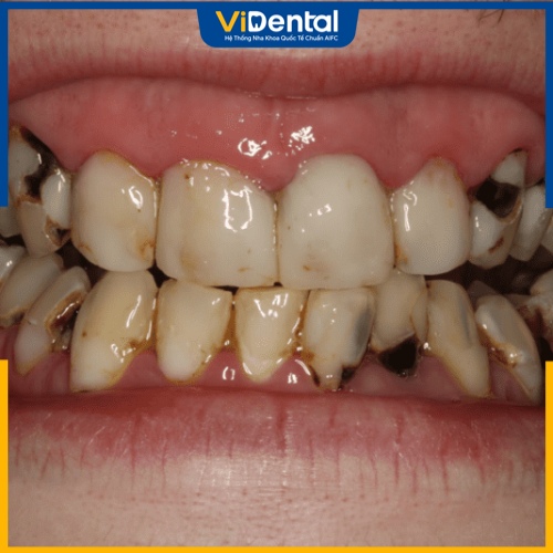 Người bị sâu răng nặng thì không thể trám răng 