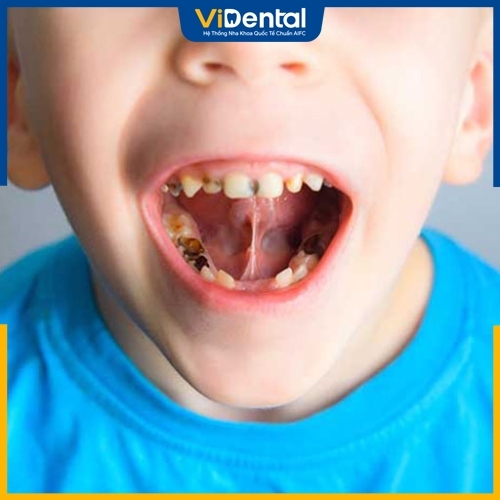Bọc răng sứ giúp xử lý nhanh chóng các vấn đề bệnh lý răng miệng