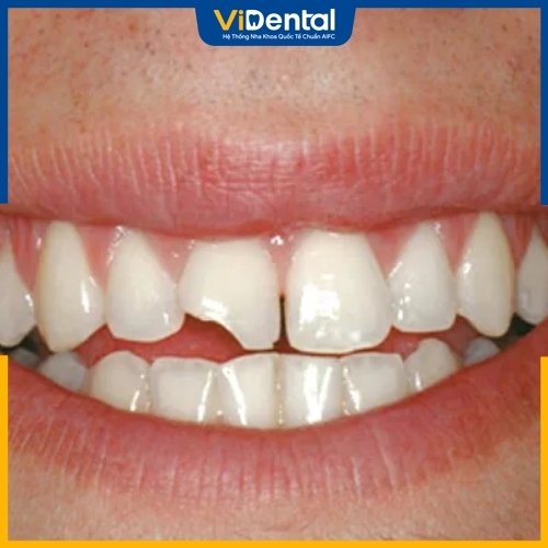Mẻ răng ảnh hưởng đến chức năng ăn nhai và thẩm mỹ