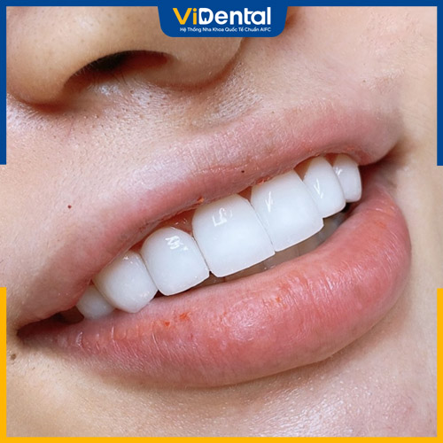 Răng sứ Cercon có độ trắng sáng tự nhiên hơn