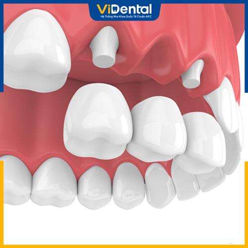 Cầu răng sứ là một trong cách phương pháp trồng răng phổ biến