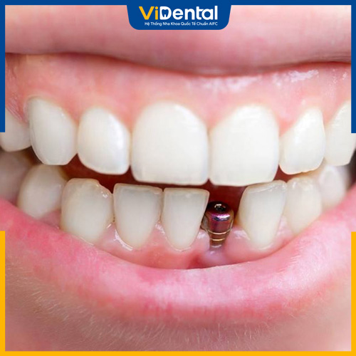 Cấy ghép Implant có thể thực hiện cho tất cả trường hợp bị mất răng