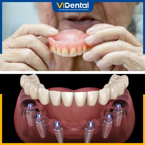 Giá làm răng giả nguyên hàm phụ thuộc vào phương pháp và vật liệu trồng răng 