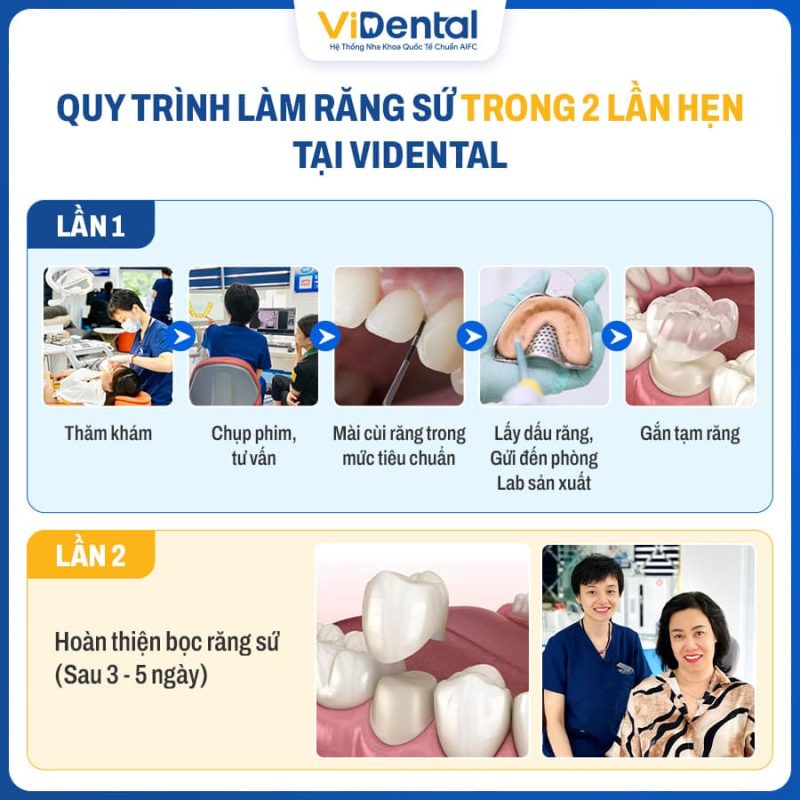 Quy trình bọc răng sứ 2 lần hẹn tại ViDental