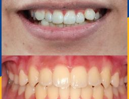 Tình trạng răng của anh Phong trước và sau khi niềng